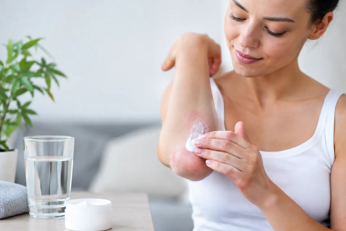 ¿La psoriasis mejora con hidratación diaria?