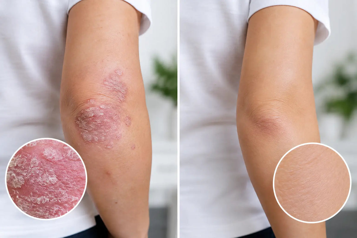 Fotografías antes después de psoriasis: cómo leerlas