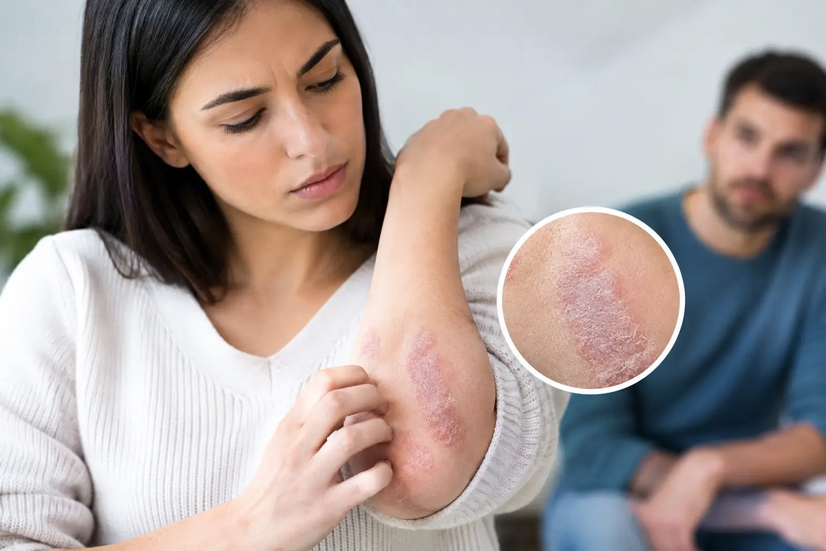 ¿La psoriasis es contagiosa? Lo que debes saber