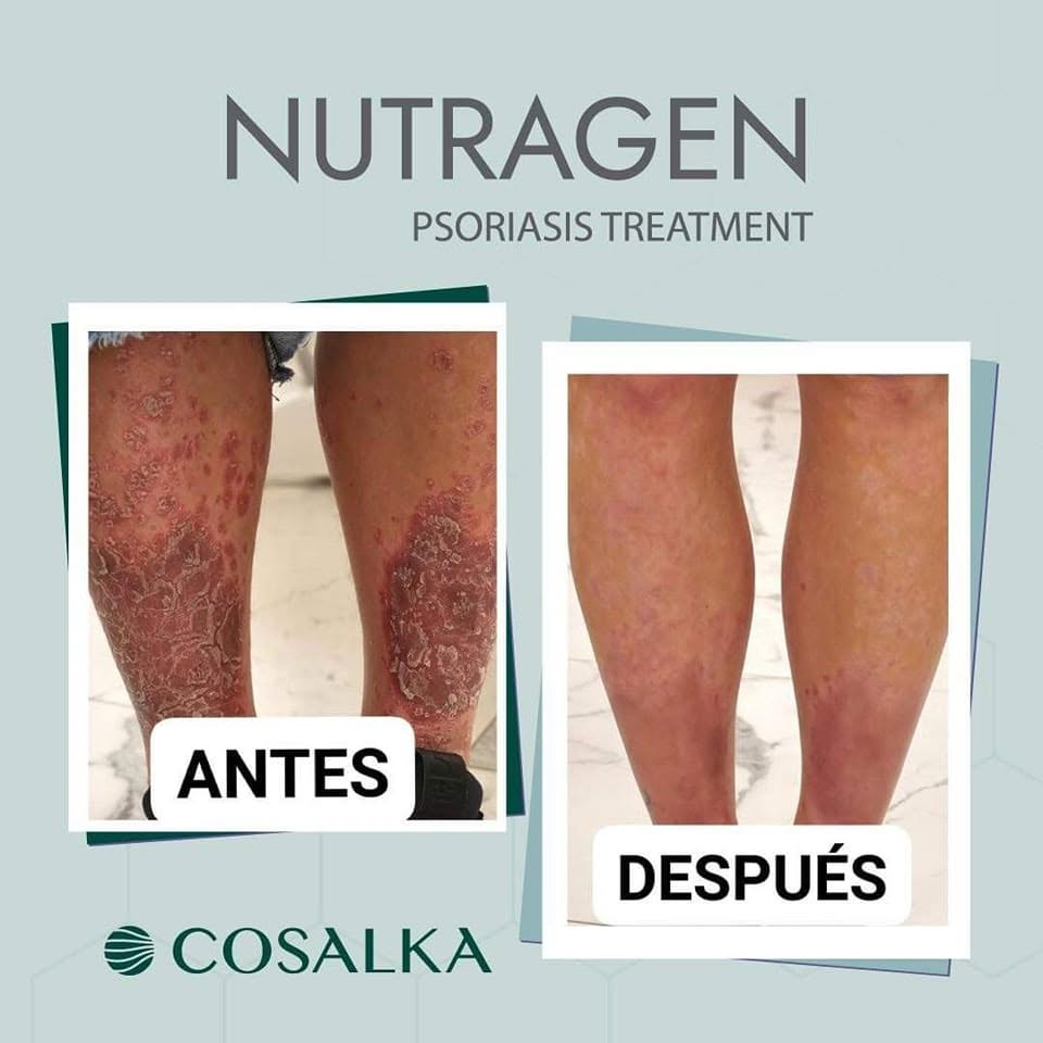 Antes y después piernas