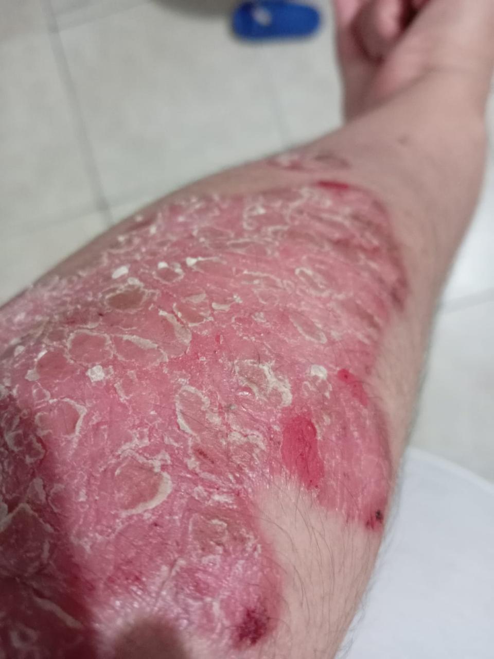 Caso brazo