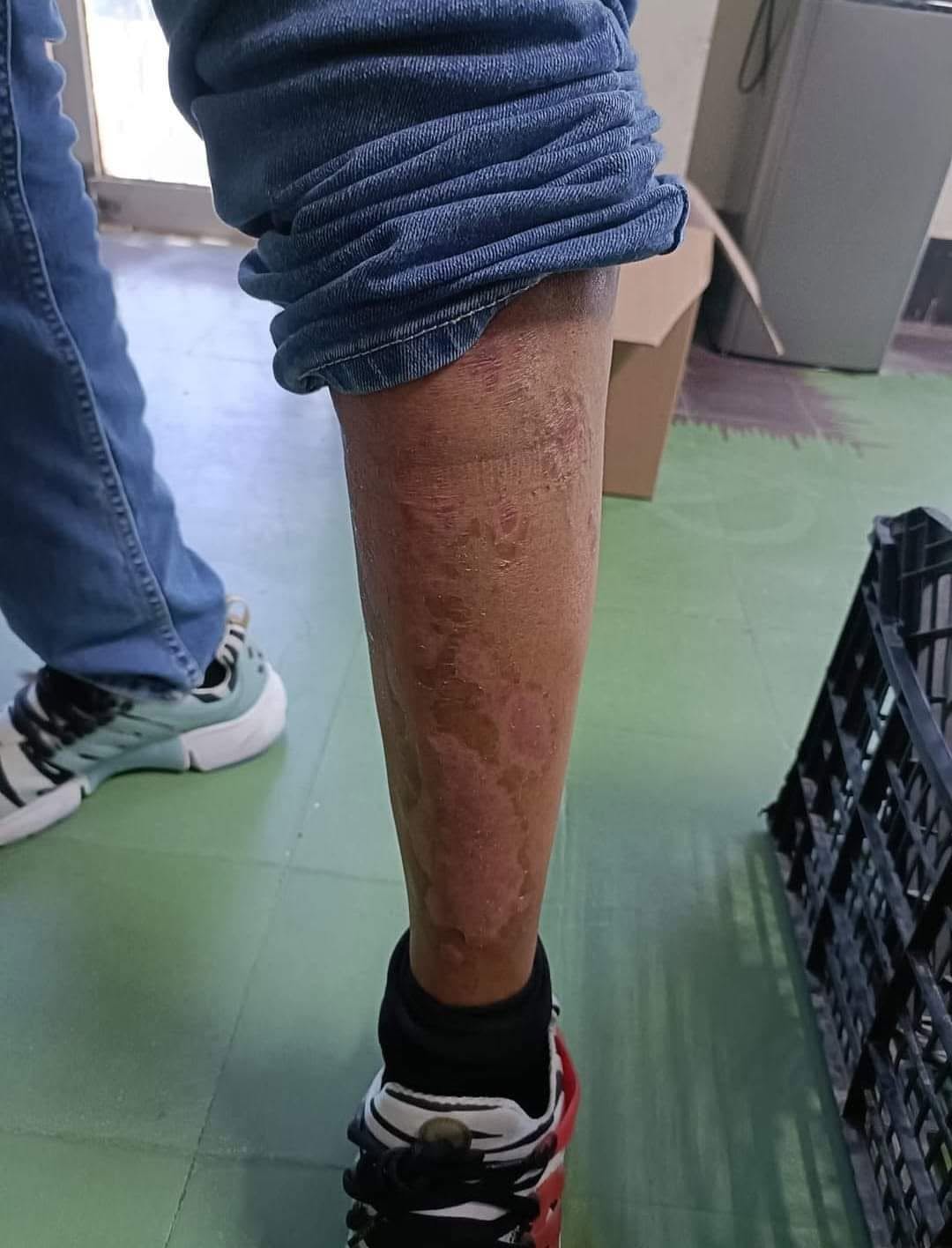 DESPUÉS · al fin pudo usar shorts