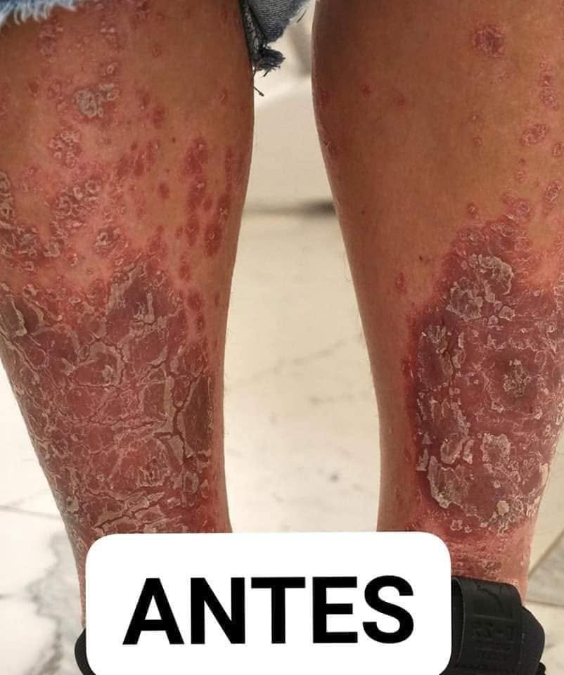ANTES · psoriasis en ambas piernas
