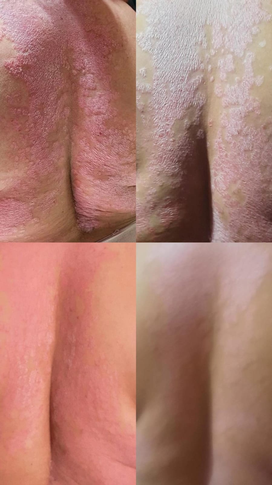 TORSO Y AXILAS · ANTES Y DESPUÉS