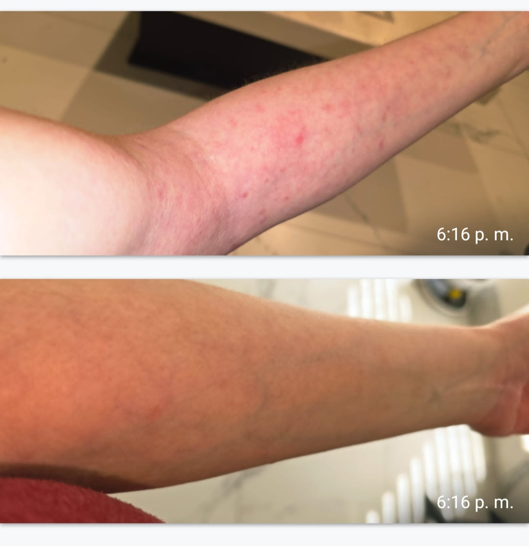 Antebrazo antes y después