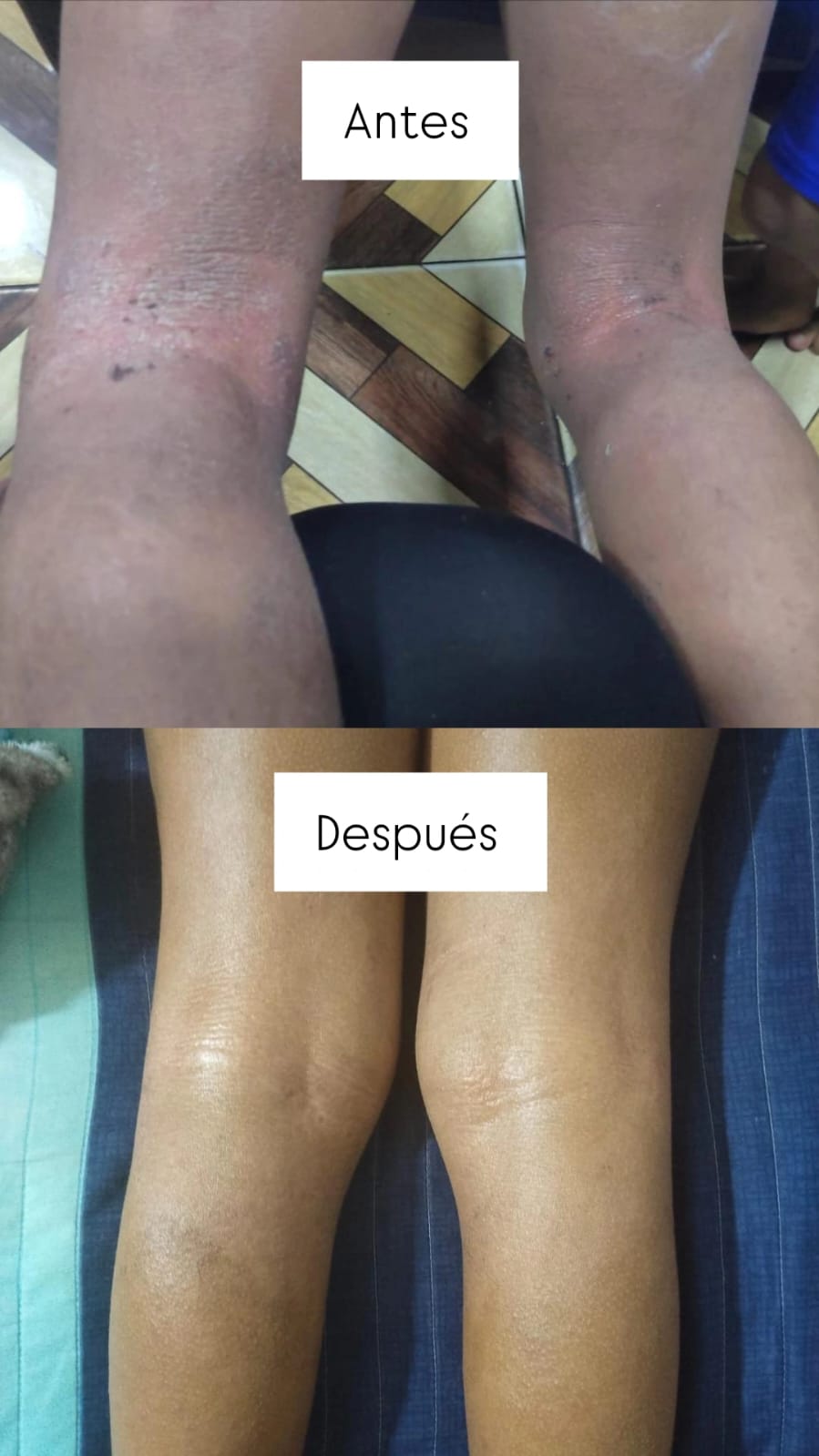 RODILLAS · ANTES Y DESPUÉS