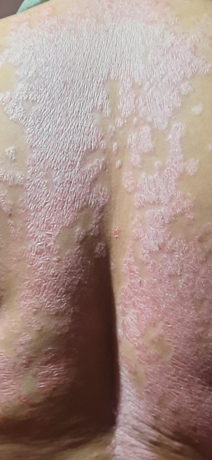 ESPALDA · ESCAMA GRUESA