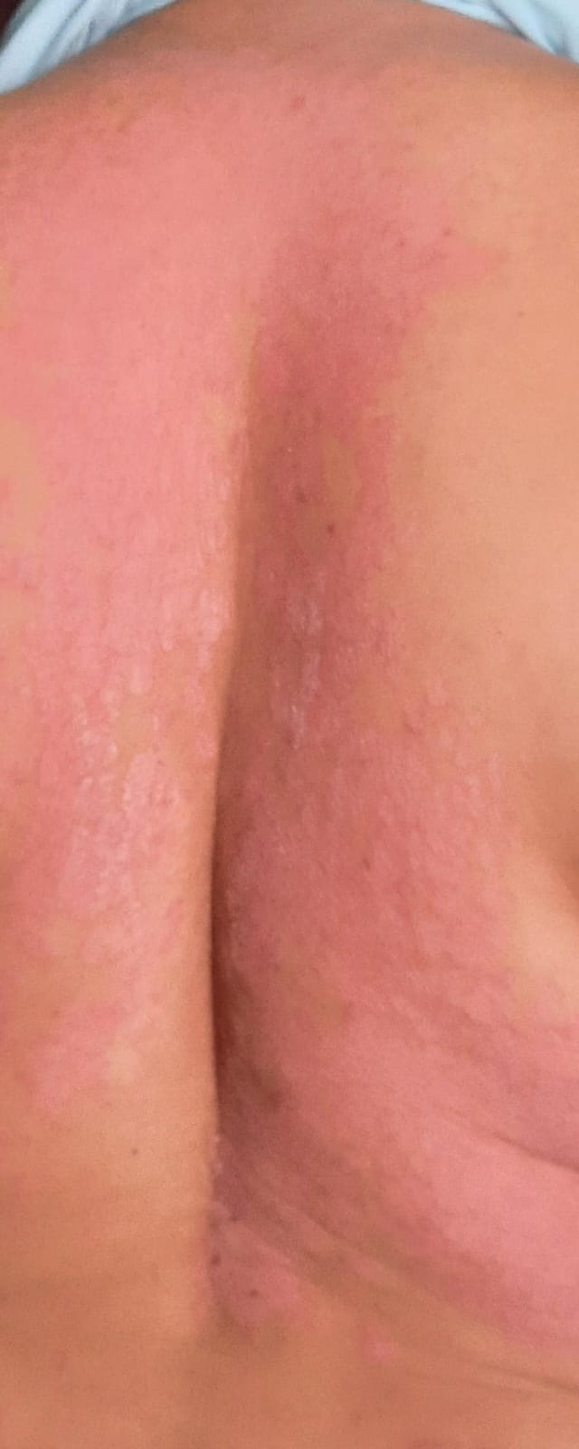Espalda con psoriasis