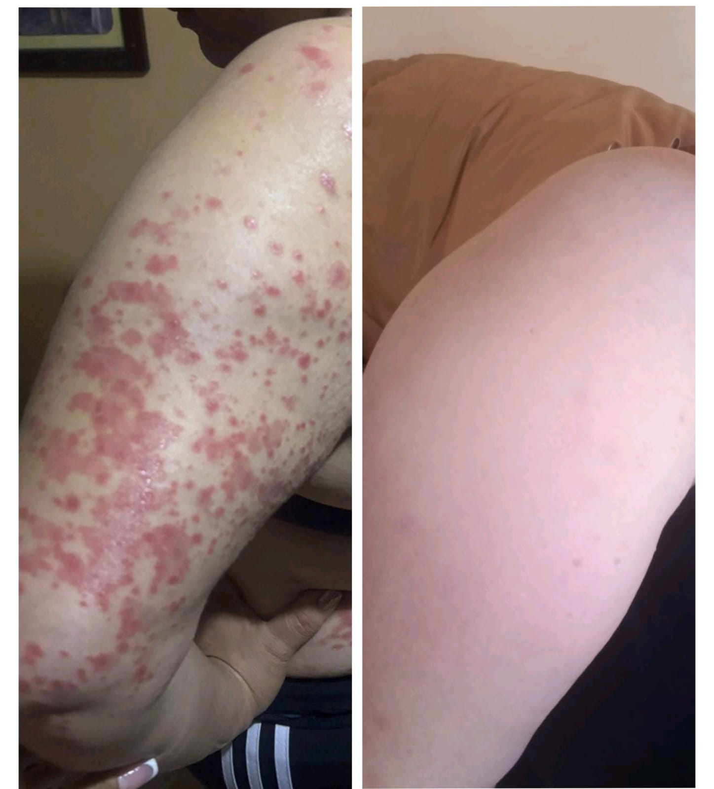 Brazo antes y después