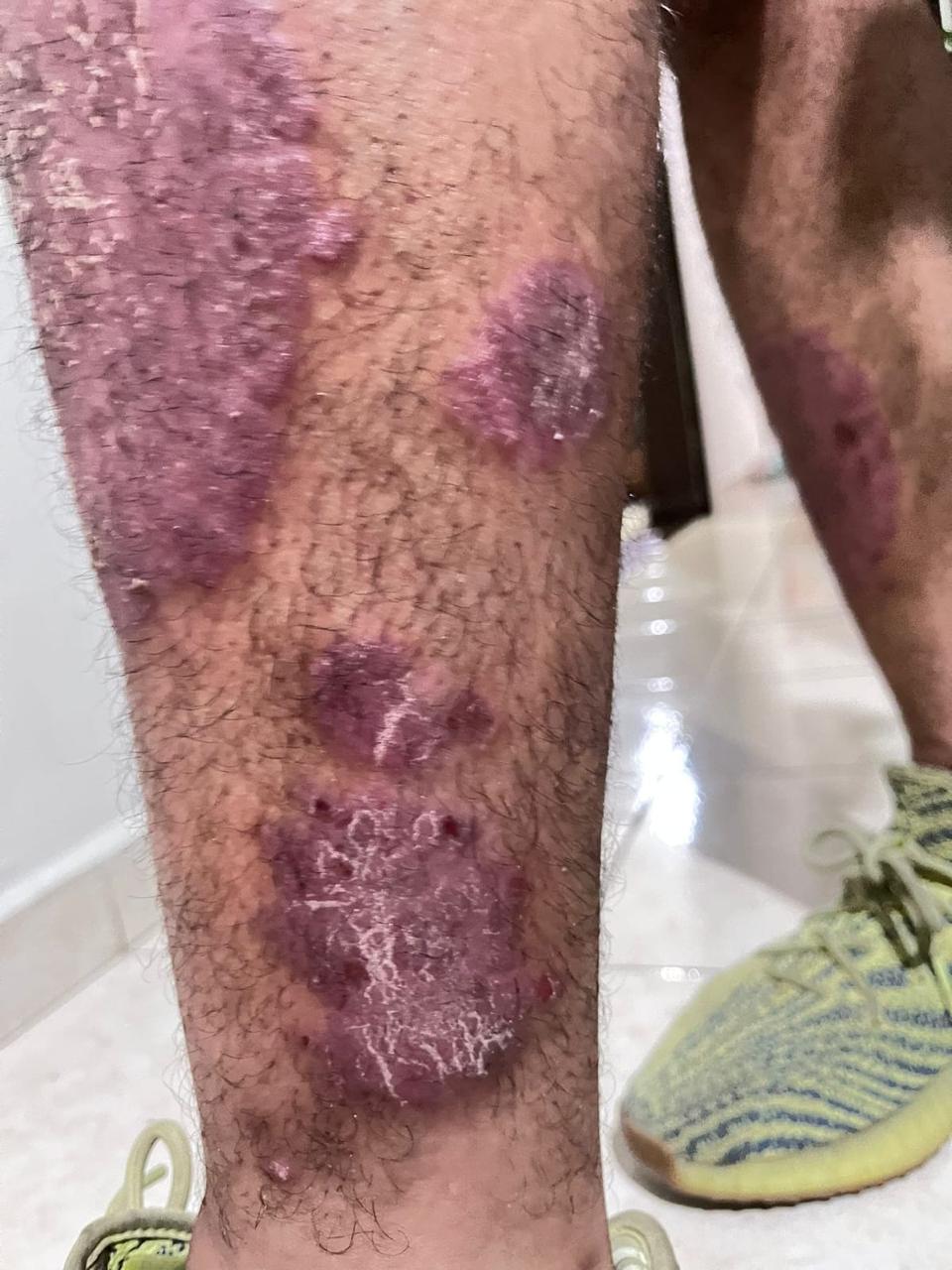 Antes del protocolo Nutragen