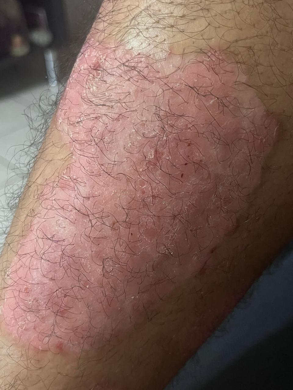 Después del protocolo Nutragen